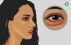 under eye bags causes home remes