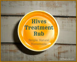 hives treatment a natural homemade