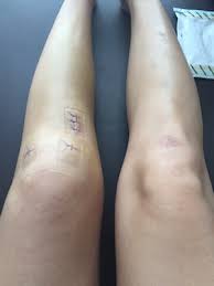 acl surgery recovery phases
