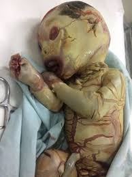 Harlequin ichthyosis is a rare, congenital skin condition. Cureus Ichthyosis Congenita Harlequin Type A Fatal Case Report