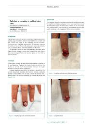 nail plate preservation in nail bed injury