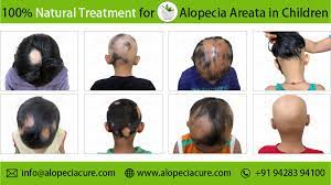 alopecia areata in children
