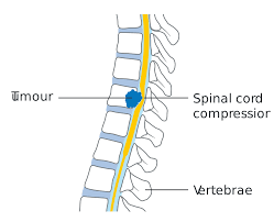 He walks you through the. Spinal Cord Compression Wikipedia