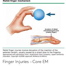Mallet Finger Mechanism Avulsion Of Distal Interphalangeal