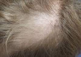 hair loss in a 12 year old clinician