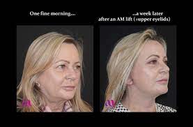 mini or midi face lift the am lift