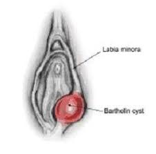 The bartholin's glands are many women will be unaware that they have a bartholin's cyst and sometimes home treatments if the cyst is infected, a visit to the doctor is recommended and a course of antibiotics is usually. Bartholin Cysts Raffles Medical Group