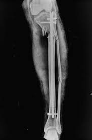 proximal tibia fractures