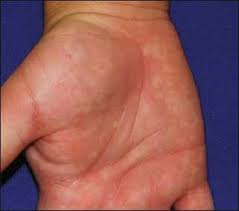 It can also be found on the soles of the feet, when it is termed plantar erythema. Palmar Erythema Springerlink