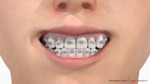 You want it to be just big enough to cover the bracket or wire irritating your mouth. Dental Braces In Hamburg Germany Zahnklinik Abc Bogen