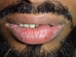 soft fluctuant swelling on lower lip