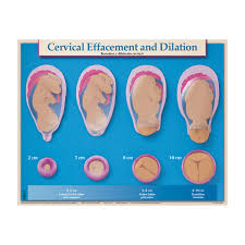 Cervical Effacement And Dilation Chart