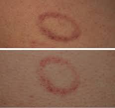 The inflammationcauses bloodvessels in the skin, intestines, kidneys,. What Explains This Annular Rash Consultant360