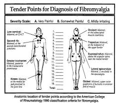 Fibromyalgia Point Chart Tender Points For Diagnosis Of