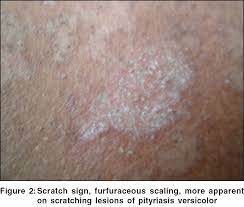scaly signs in dermatology indian