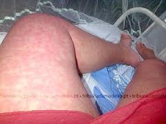 Resultado de imagem para febre chikungunya manchas