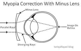 Myopia What Does Actually Mean Tariq Al Fayad Blog