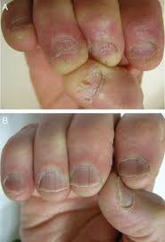 inflammatory nail disorders