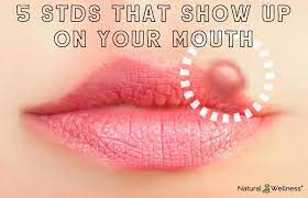 5 common stds of the mouth