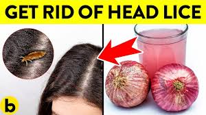 what does lice look like in dark hair