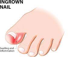 ingrown toenail keeps coming back