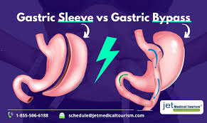gastric sleeve vs gastric byp jet