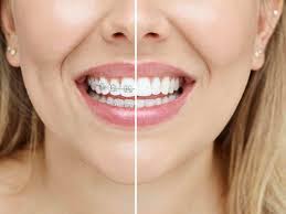 But recent advancements in dental technology have opened up many other options for straightening your teeth. Straight Teeth Without Braces Anokhi Dental