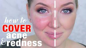 cover acne redness makeup