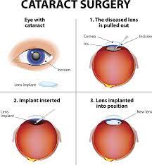 cataract surgery portland or the eye