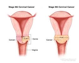 Stage 4 means the cancer has spread to parts of the body outside the cervix and womb. Cervical Cancer Treatment Pdq Treatment Patient Information Nci Michigan Medicine