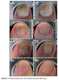 toenail fungus cold laser or lllt can