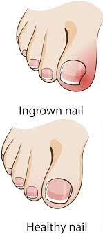 a doctor for an ingrown toenail