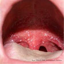 Candidiasis in the mouth and throat can have many different symptoms, including: Mundsoor Und Parotitisprophylaxe Mitpflegeleben De