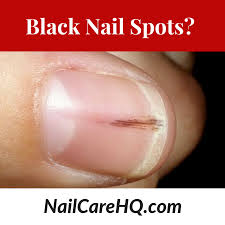 ask ana black spots in nails nail