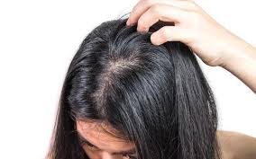 A yogurt hair mask is one of the best remedies to get rid of oily hair naturally. Oily Greasy Scalp Try These Holistic Ayurvedic Treatments Vedix