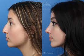 nose tip surgery over full rhinoplasty