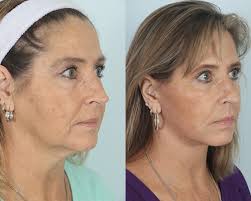 best facelift surgery in the woodlands