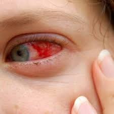 5 types of eye infections that you