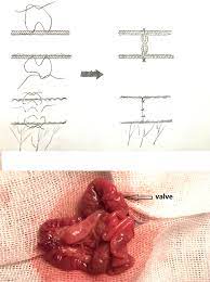 artificial colonic valve