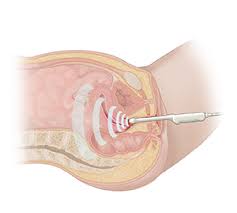 Diagnostic purposes of a pelvic ultrasound include: Pelvic Ultrasound Saint Luke S Health System