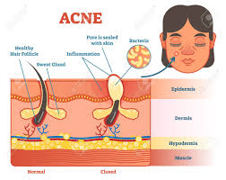 Pimples On Face Diagram Wiring Diagrams