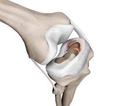 meniscal injuries orthopaedic