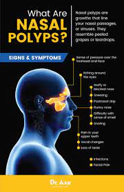 nasal polyps 19 natural treatments
