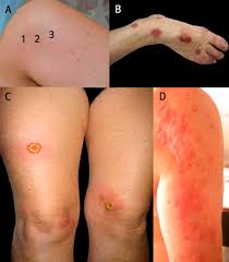 Bite mark, sting or sore on human skin. Clinical Manifestations Of Bed Bug Bites Three Or Four Skin Lesions Download Scientific Diagram