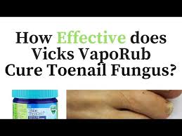 vicks vapor rub for toenail fungus