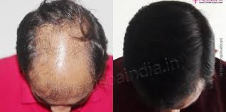 shock loss post hair transplant what