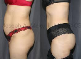 If this is your first time here welcome! Brazilian Tummy Tucks Bbl Abdominoplasty