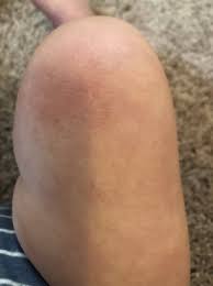 red rash on knees from crawling