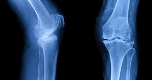 treating knee osteoarthritis without