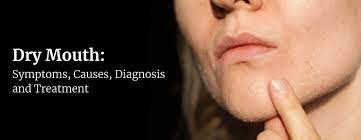 dry mouth symptoms causes diagnosis